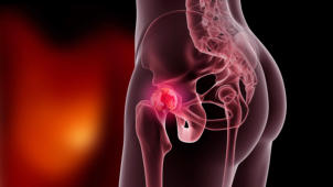 m01_039 Patientin mit Kox-Arthrose im linken H�ftgelenk