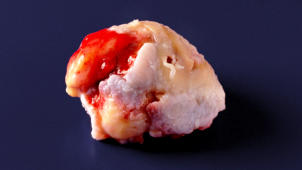 m01_037 Im OP entfernter H�ftgelenkskopf mit schwerer Kox-Arthrose