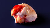 m01_037 Im OP entfernter H�ftgelenkskopf mit schwerer Kox-Arthrose